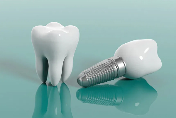 Dental Implants