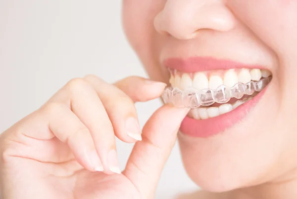 Clear Aligners